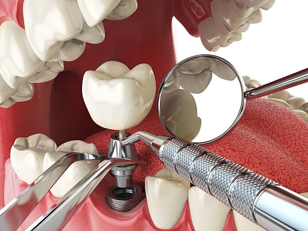 Best Emergency Dental Care for Broken or Chipped Teeth in Montague, CA